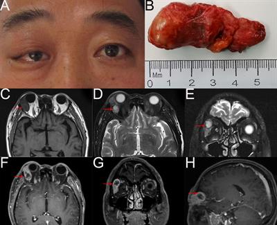 Lacrimal gland mucoepidermoid carcinoma with contralateral eye and systemic metastasis: A rare case report and review of the literature